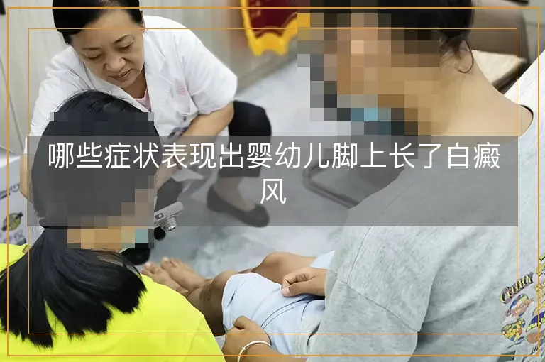 哪些症状表现出婴幼儿脚上长了白癜风