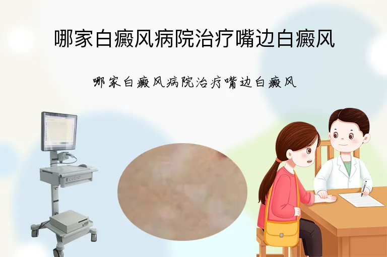 哪家白癜风病院治疗嘴边白癜风