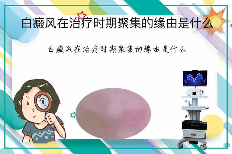 白癜风在治疗时期聚集的缘由是什么