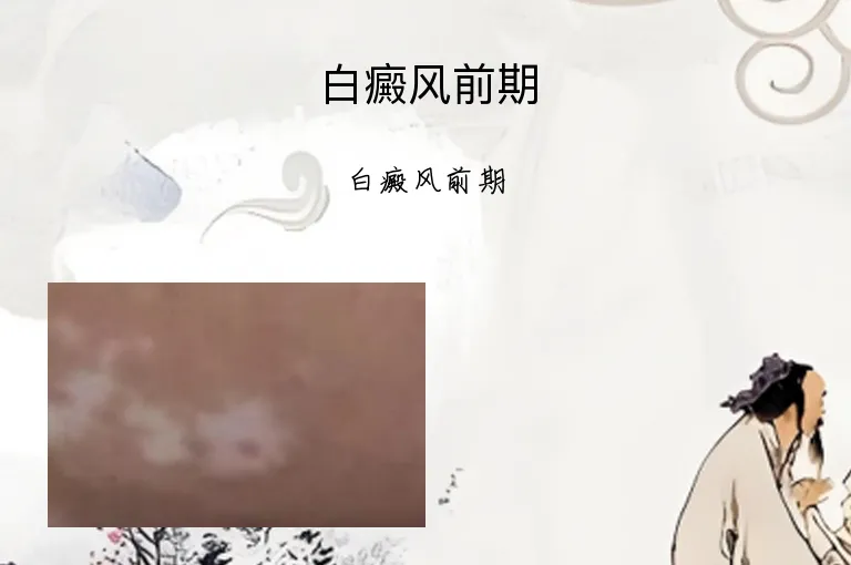 白癜风前期