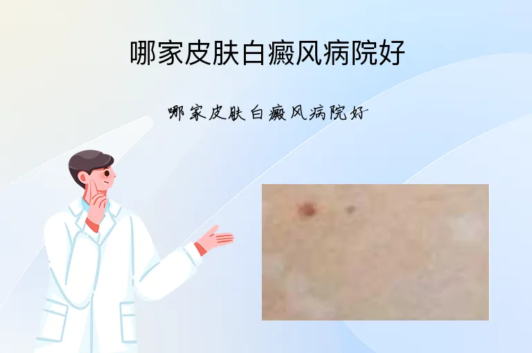 哪家皮肤白癜风病院好