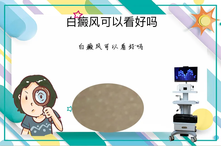 白癜风可以看好吗