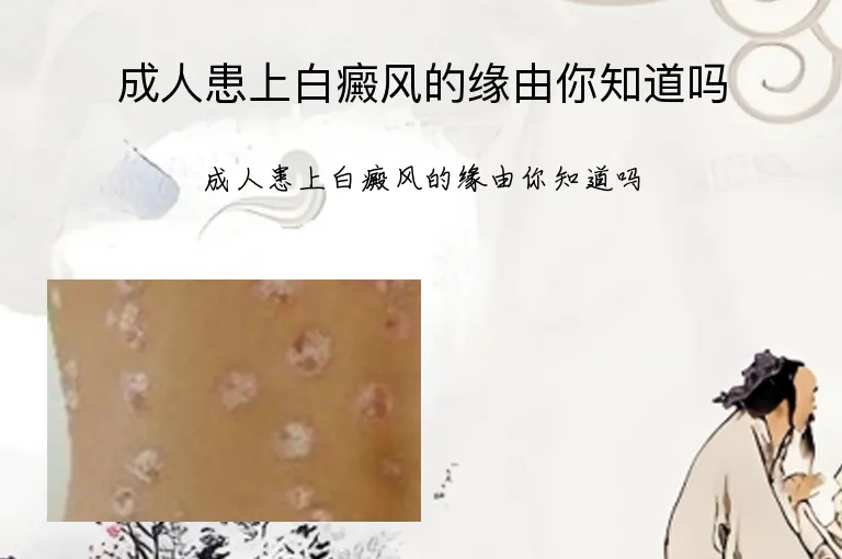 成人患上白癜风的缘由你知道吗