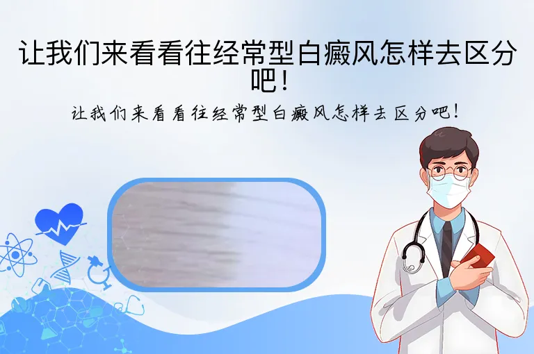 让我们来看看往经常型白癜风怎样去区分吧！