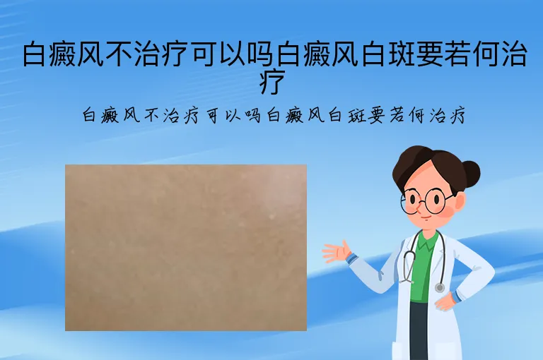 白癜风不治疗可以吗白癜风白斑要若何治疗