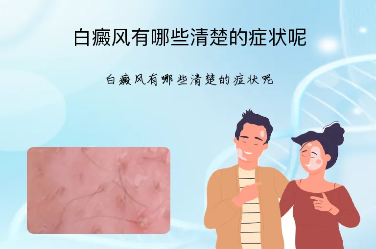 白癜风有哪些清楚的症状呢