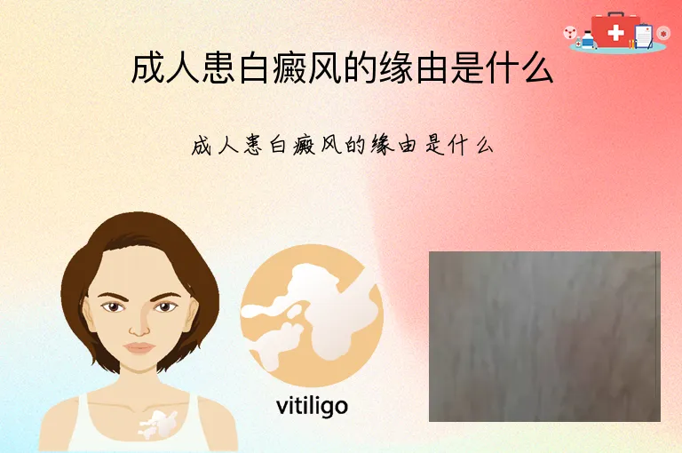 成人患白癜风的缘由是什么