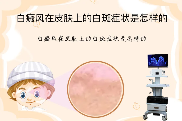 白癜风在皮肤上的白斑症状是怎样的