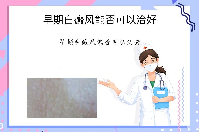 早期白癜风能否可以治好