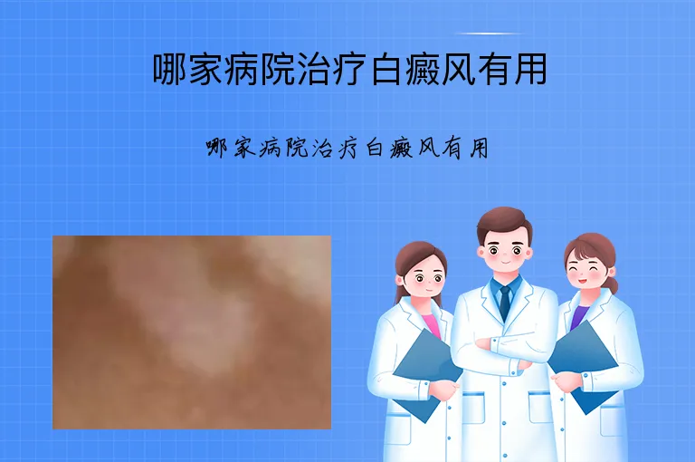 哪家病院治疗白癜风有用