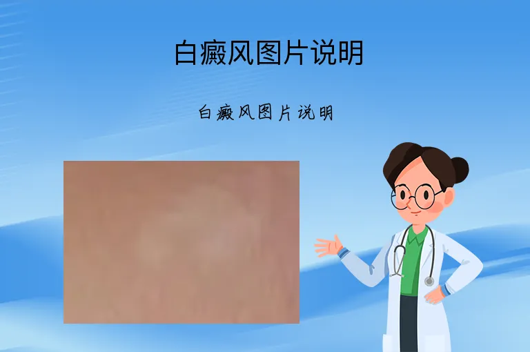 白癜风图片说明