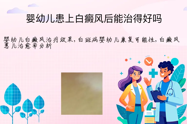 婴幼儿患上白癜风后能治得好吗