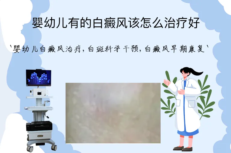 婴幼儿有的白癜风该怎么治疗好