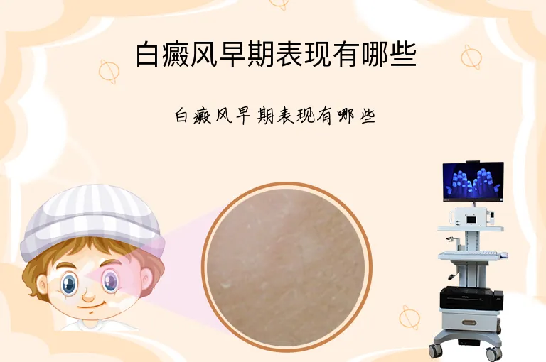 白癜风早期表现有哪些