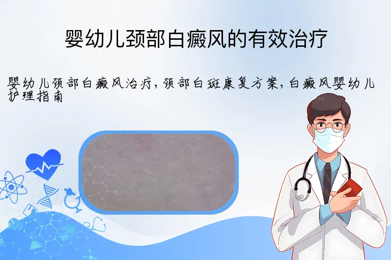 婴幼儿颈部白癜风的有效治疗
