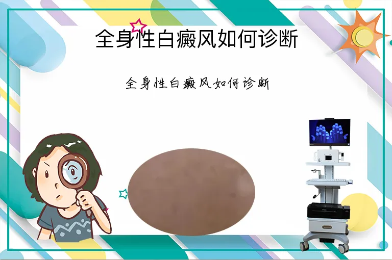 全身性白癜风如何诊断