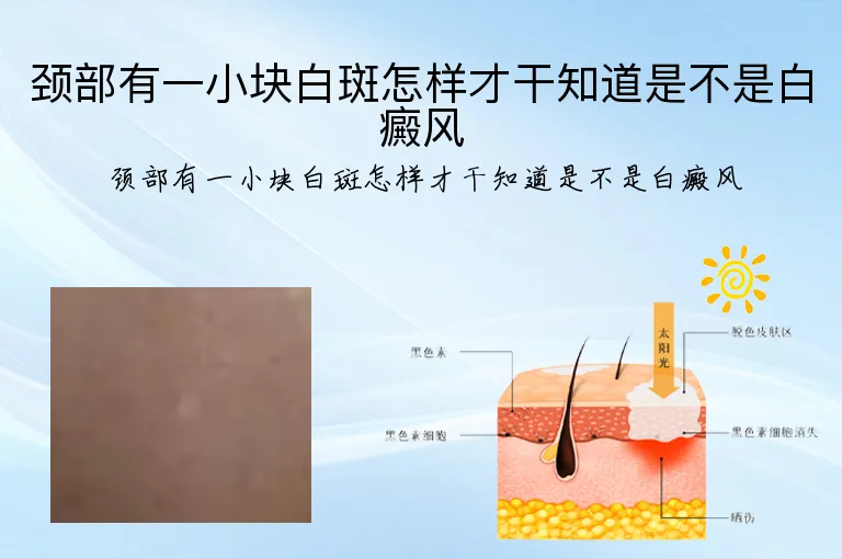 颈部有一小块白斑怎样才干知道是不是白癜风