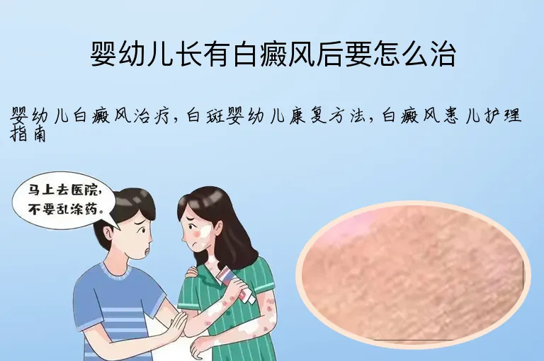 婴幼儿长有白癜风后要怎么治