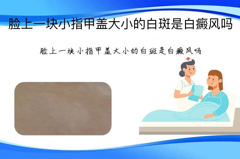 脸上一块小指甲盖大小的白斑是白癜风吗