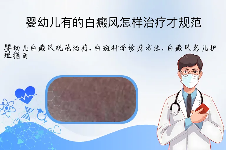 婴幼儿有的白癜风怎样治疗才规范