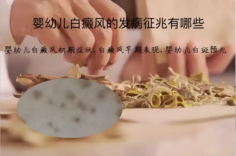 婴幼儿白癜风的发病征兆有哪些