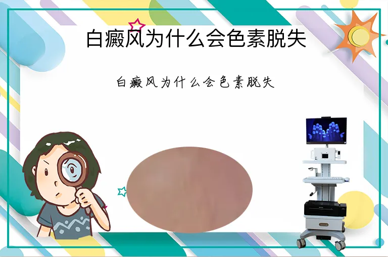 白癜风为什么会色素脱失