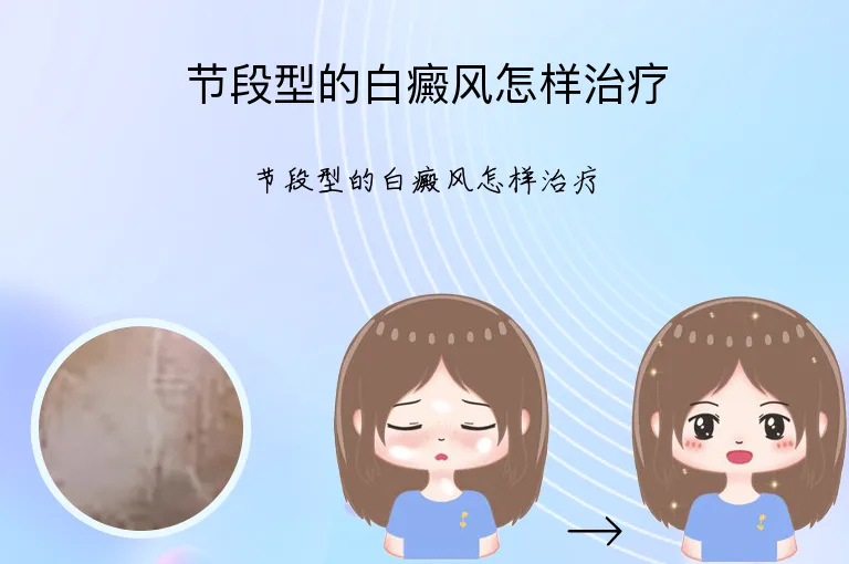 节段型的白癜风怎样治疗