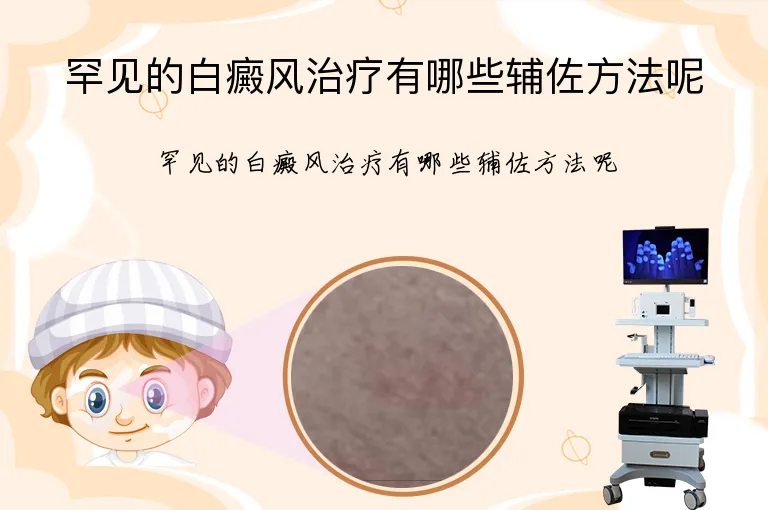 罕见的白癜风治疗有哪些辅佐方法呢