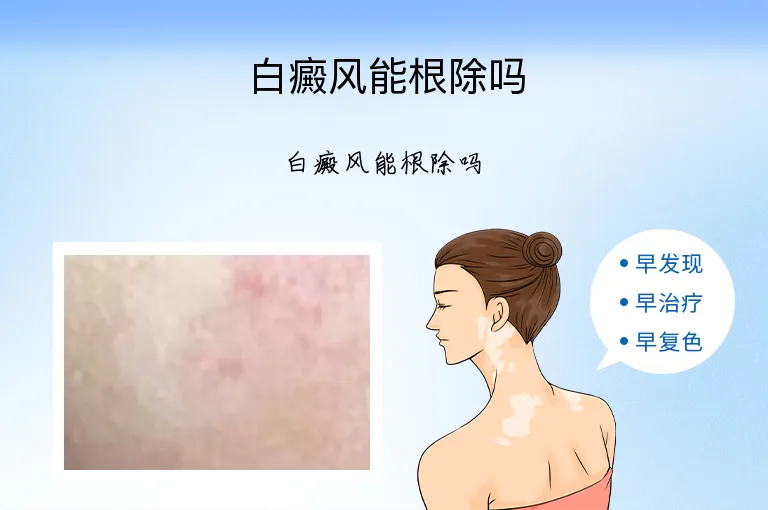 白癜风能根除吗