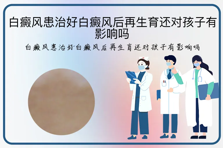 白癜风患治好白癜风后再生育还对孩子有影响吗