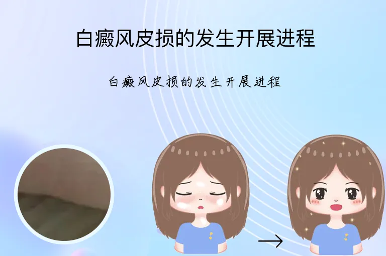 白癜风皮损的发生开展进程