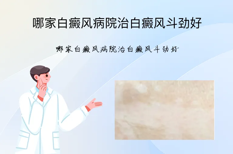 哪家白癜风病院治白癜风斗劲好