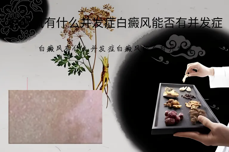 白癜风有什么并发症白癜风能否有并发症