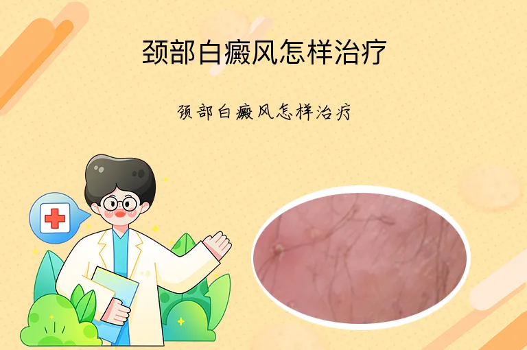 颈部白癜风怎样治疗