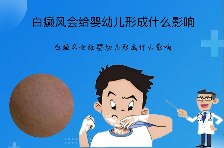 白癜风会给婴幼儿形成什么影响