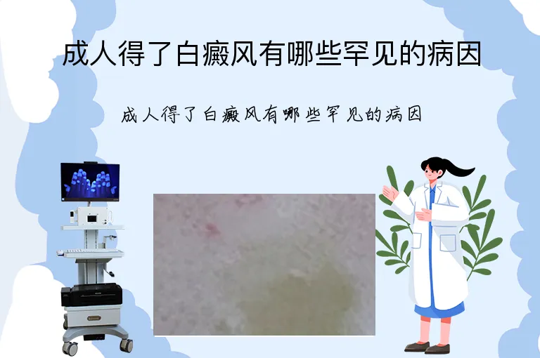 成人得了白癜风有哪些罕见的病因