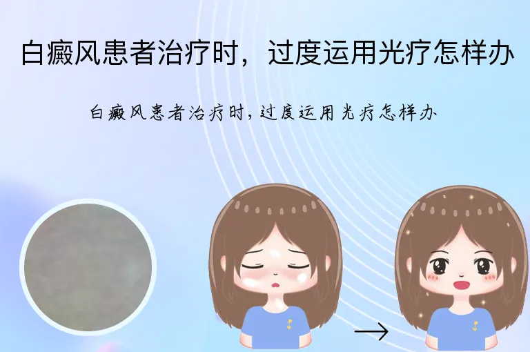 白癜风患者治疗时，过度运用光疗怎样办