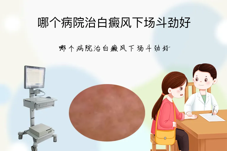 哪个病院治白癜风下场斗劲好