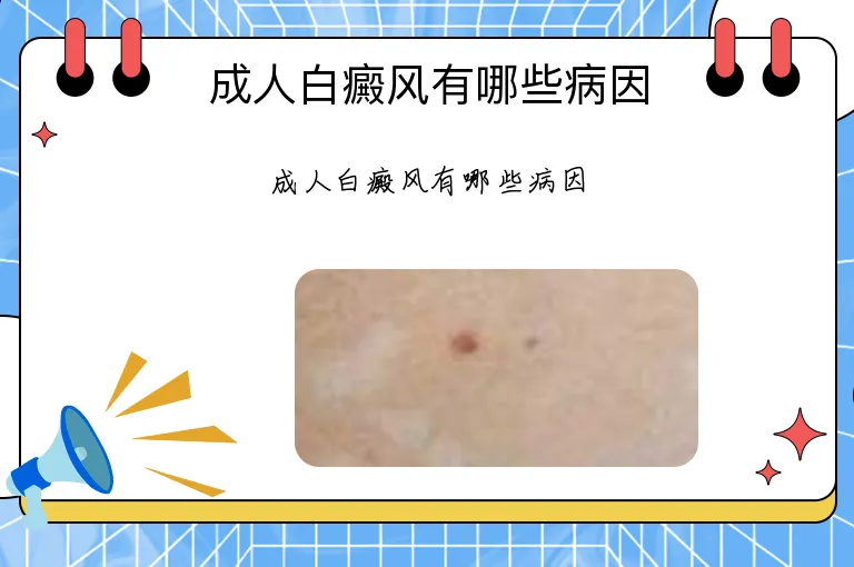 成人白癜风有哪些病因