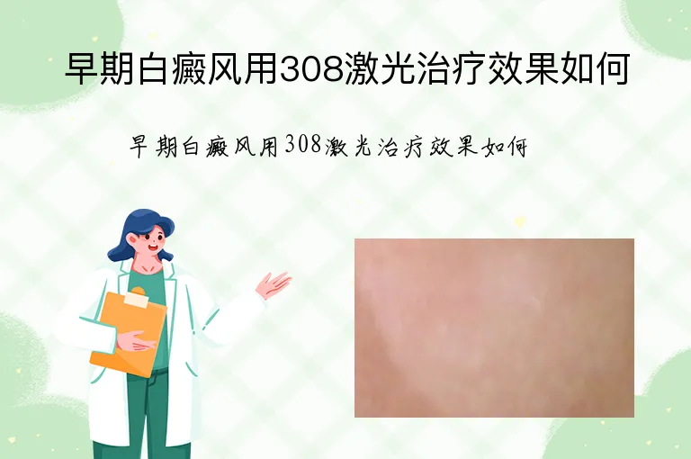 早期白癜风用308激光治疗效果如何