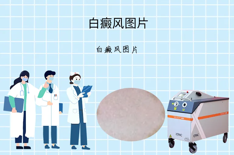 白癜风图片