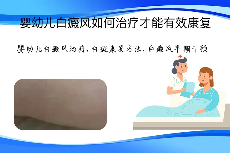 婴幼儿白癜风如何治疗才能有效康复