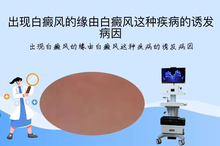 出现白癜风的缘由白癜风这种疾病的诱发病因