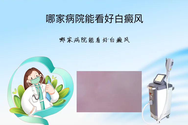 哪家病院能看好白癜风