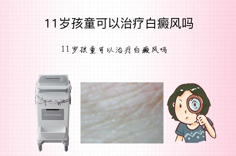 11岁孩童可以治疗白癜风吗