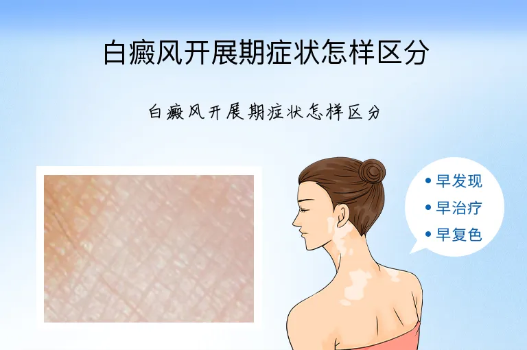 白癜风开展期症状怎样区分