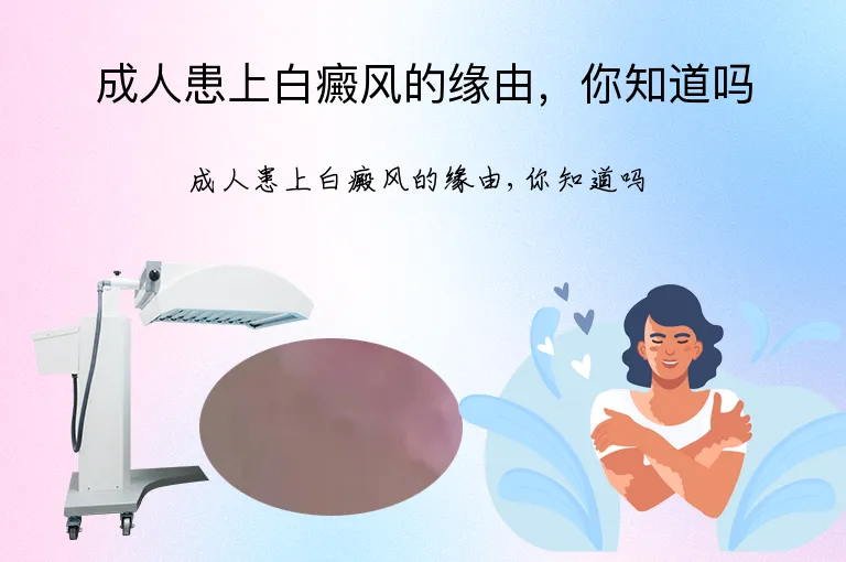 成人患上白癜风的缘由，你知道吗