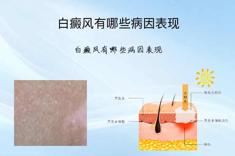白癜风有哪些病因表现