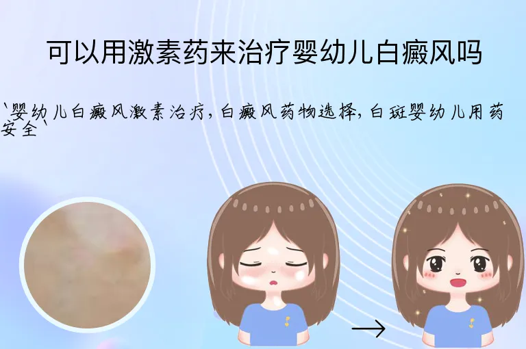 可以用激素药来治疗婴幼儿白癜风吗