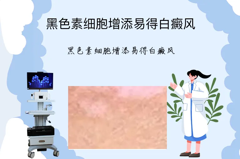 黑色素细胞增添易得白癜风